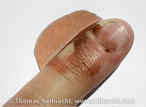 Finger Silbernitrat